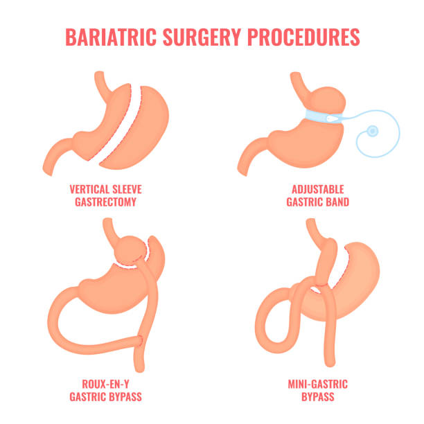 bariatrische chirurgie gewichtsverlust verfahren medizinische infografiken - surgery stock-grafiken, -clipart, -cartoons und -symbole