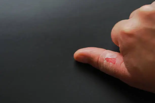 skinning skin between the fingers, the hands of one person injured,