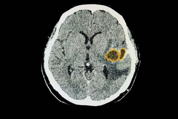 A CT brain scan of a patient with large brain abscesses. A CT brain scan of a patient with large brain abscesses in her left temporal lobe. abscess stock pictures, royalty-free photos & images