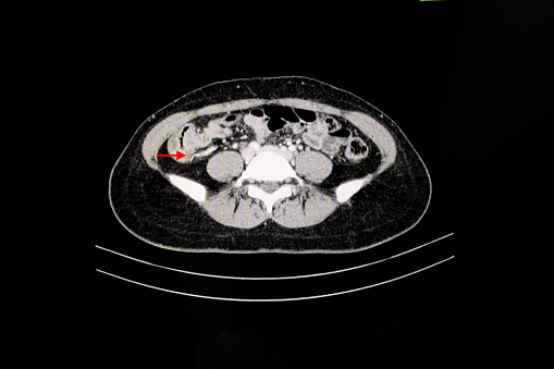 CT Scan of an abdomen of a patient with abdominal pain showing swollen appendix suggesting the diagnosis of acute appendicitis.