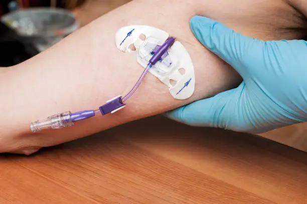 Photo of Doctor checks the PICC line on the arm of a woman undergoing chemotherapy for breast cancer