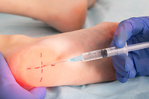 Inyección médica con un medicamento en el talón del pie del paciente con una enfermedad de espolón de talón, un crecimiento de osteofito, primer plano photo