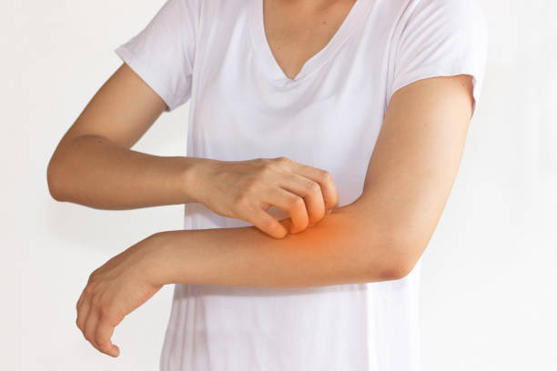 istock Women scratch itchy arm with hand 1317598559