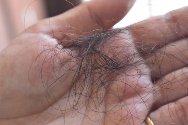 istock hair loss problem on hand closeup 1317737872