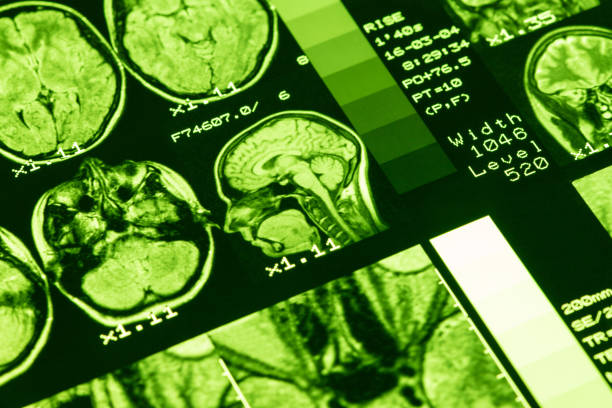 risonanza risonanza cerebrale di una persona sana con illuminazione verde. risonanza magnetica. concetto di assistenza sanitaria medica - mri scan human nervous system brain medical scan foto e immagini stock