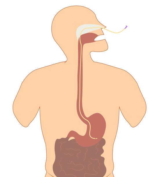 Enteral Nutrition - Banco de fotos e imágenes de stock - iStock Enteral Nutrition - Banco de fotos e imágenes de stock - iStock