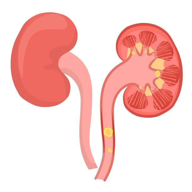 在白色背景上隔離的腎結石的載體圖示。腎病的概念 - 腎結石 幅插畫檔、美工圖案、卡通及圖標