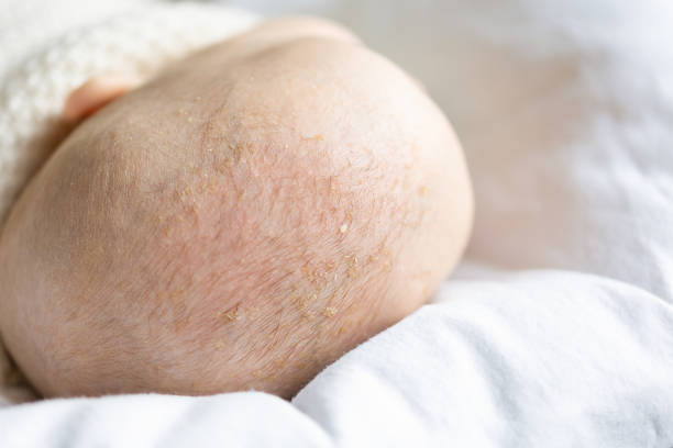 istock seborrheic dermatitis on baby's scalp 1318099379