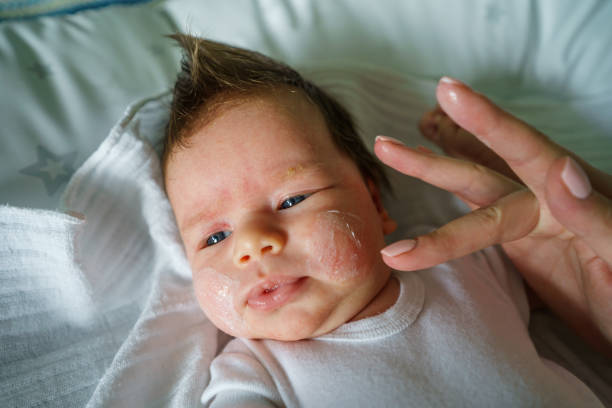 istock Neurodermatitis Chronic constitutional atopic eczema small newborn baby with dry skin problem on her face and hands of mother with medicine cream applying while lying on bed at home 1318209679