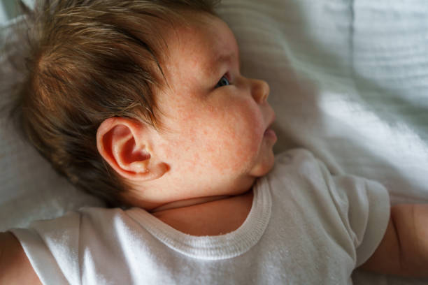 neurodermatitis przewlekłe konstytucyjne wyprysk atopowy małe noworodki z problemem suchej skóry na twarzy leżącej na łóżku w domu - lubrication infection zdjęcia i obrazy z banku zdjęć