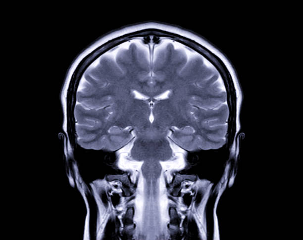 visión coronal cerebral mri para detectar una variedad de condiciones del cerebro como quistes, tumores, sangrado aislado en la pantalla. - mri scan human nervous system brain medical scan fotografías e imágenes de stock