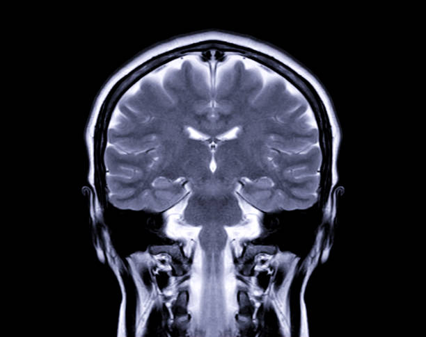 irm cerveau coronal t2w vue pour détecter une variété de conditions du cerveau tels que les kystes, tumeurs, saignements isolés à l’écran. - mri scan human nervous system brain medical scan photos et images de collection