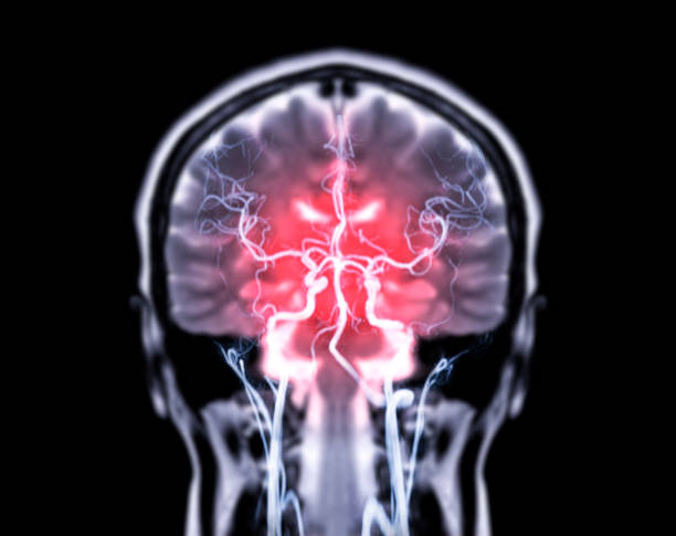 irm cerveau coronal t2w et mra fusion du cerveau dans la vue coronal. - mri scan human nervous system brain medical scan photos et images de collection