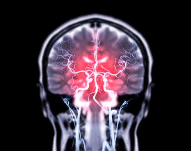 cérebro de ressonância magnética coronal t2w e mra fusão cerebral em vista coronal. - mri scan human nervous system brain medical scan - fotografias e filmes do acervo
