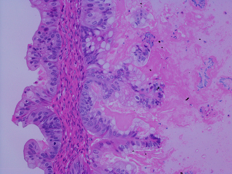 Metastatic pancreatic ductal adenocarcinoma: Metastatic pancreatic cancer is cancer that starts in the pancreas and spreads to other organs, most commonly within the abdomen and to the liver, lungs, bones and brain. No matter where it spreads in the body, it is still considered pancreatic cancer.