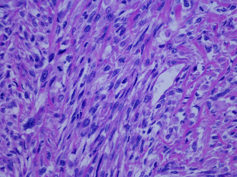 Undifferentiated pleomorphic sarcoma (UPS) encompasses rare neoplasms that can arise either in the dermis or in the subfascial soft tissue. The behavior of UPS ranges from indolent to aggressive, but data predicting outcomes are limited.
