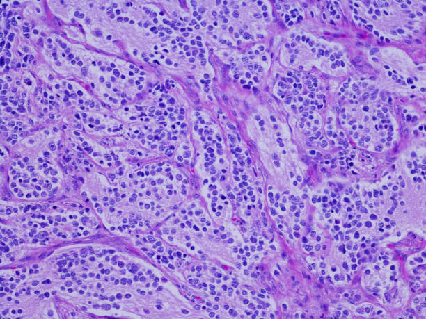 Neuroblastoma Neuroblastoma  is a cancer that develops from immature nerve cells found in several areas of the body. Neuroblastoma most commonly arises in and around the adrenal glands, which have similar origins to nerve cells and sit atop the kidneys. human tissue stock pictures, royalty-free photos & images