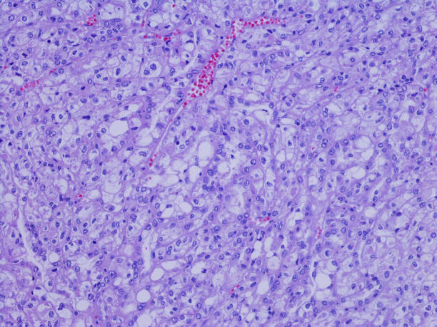 istock Renal Cell Carcinoma 1318279889