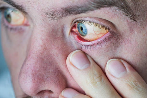 ludzkie oko z żółtą gałką oczną, zbliżenie. żółte oczy są objawem choroby wątroby lub zapalenia wątroby - yellow eyes zdjęcia i obrazy z banku zdjęć