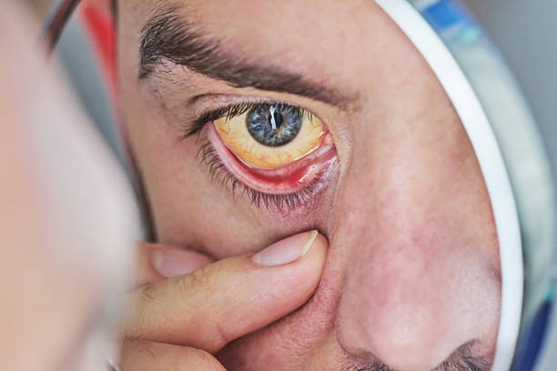 ojo humano con globo ocular amarillo, primer plano. los ojos amarillos son un síntoma de enfermedad hepática o hepatitis - ojos amarillos fotografías e imágenes de stock