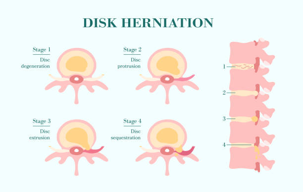 illustrations, cliparts, dessins animés et icônes de herhetation de disque, quatre étapes et vue latérale de colonne vertébrale - spinal nerve