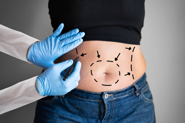 abdominoplasty obesity surgery - abdominoplastia imagens e fotografias de stock