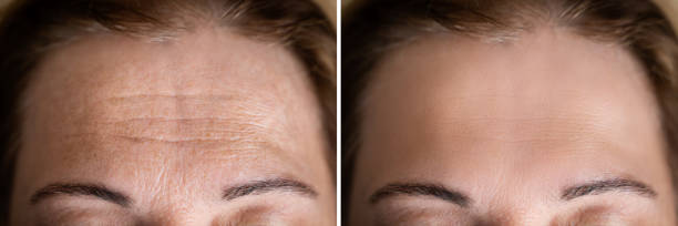 Age Anti Forehead Wrinkles Treatment Before Age Anti Forehead Wrinkles Treatment Before And After wrinkled forehead stock pictures, royalty-free photos & images