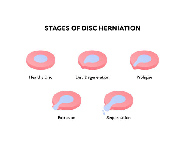 illustrations, cliparts, dessins animés et icônes de étapes de disque de colonne vertébrale de l’hernie. illustration anatomique plate de vecteur. ensemble d’icônes. sain, dégénérescence, prolapsus, saillie, stade de séquestration. conception pour la science, la biologie, les soins de santé. - dégénératif
