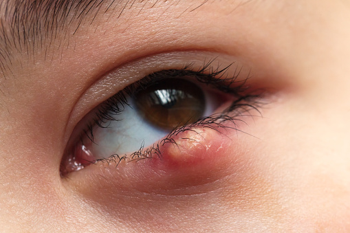 Close up of the eye of a child with a stye infection in the lower eyelid.