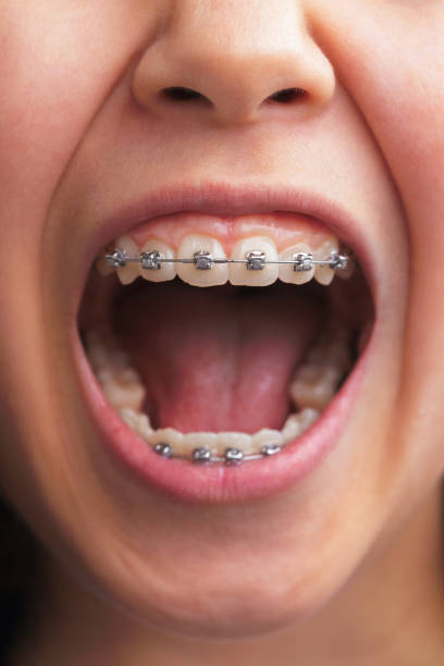 Close up of the wide open mouth of a girl wearing dental braces.