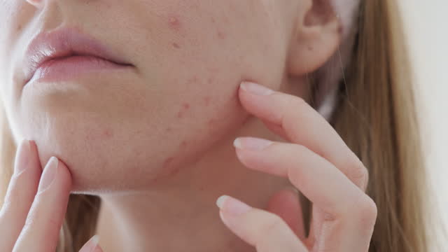 Sad woman touching her skin with irritation acne caused by protective face mask.