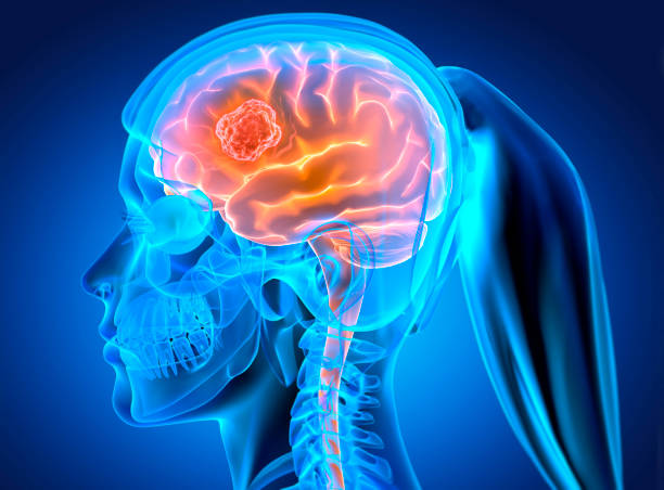 istock Woman with brain tumor 1318623833