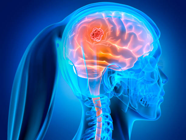 istock Woman with brain tumor 1318623834