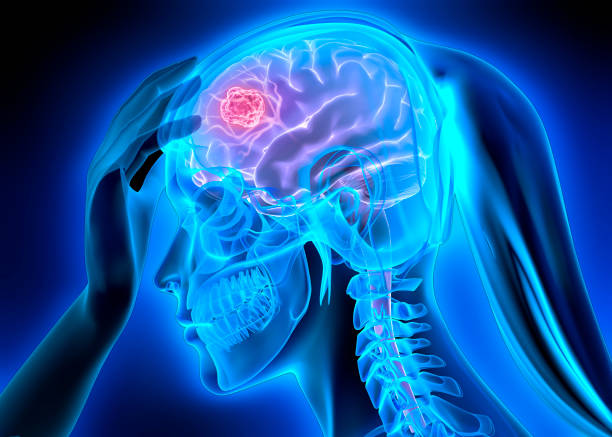istock Woman with brain tumor 1318707597