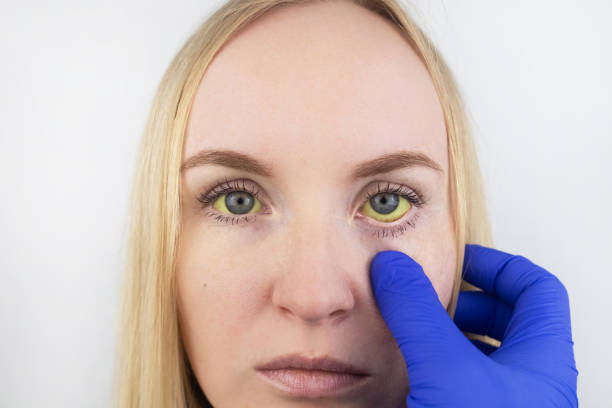 желтый цвет глаза женщины. симптомы желтухи, гепатита или проблемы с желчным пузырем, желудочно-кишечным трактом, печенью. желтый глаз при з - yellowing стоковые фото и изображения