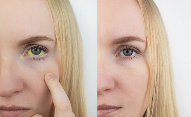 istock Before and after. Left yellow eye, right normal. Symptom of jaundice, hepatitis or problems with the gall bladder, gastrointestinal tract, liver. Diseases of the liver, cirrhosis, hepatitis, bilirubin 1318842892