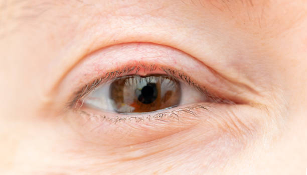 woman's eye with a bacterial infection Close up of a woman's eye with a bacterial infection of an oil gland in the lower eyelid. life stile stock pictures, royalty-free photos & images