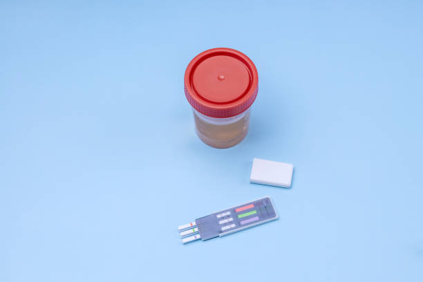 istock a jar for urine tests and test strips on a blue background 1318882501