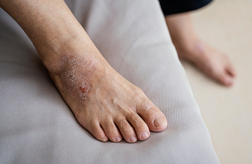 unrecognizable mature woman having an exfoliating skin peeling on her feet for calluses and corns. concept of dead skin, body care and pedicure.vertical image