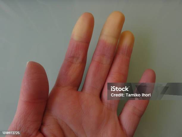 Hc Raynaud A Hand With Raynaud Syndrome Symptom Appearing Stock Photo - Download ...