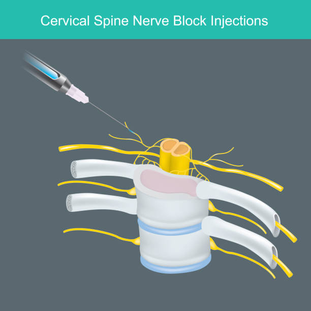Cervical Spine Nerve Block Injections. Illustration for learning Anesthetic solution injected the human neck cervical spine nerve."n vector art illustration