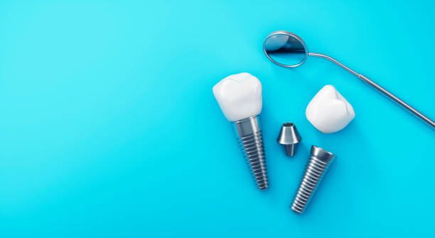 implants dentaires d’isolement sur le fond bleu - implant photos et images de collection
