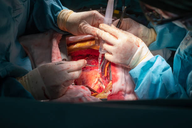 coronary artery bypass graft operation (CABG). stock photo