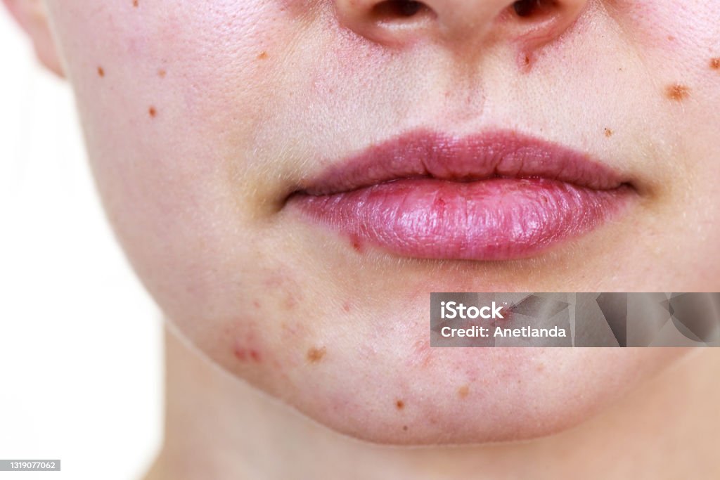 Female face with acne skin problem Young woman showing her face with acne and moles, dry lips. Teen girl no make up with red spots on her chin. Health problem, skin diseases. Pimple Stock Photo
