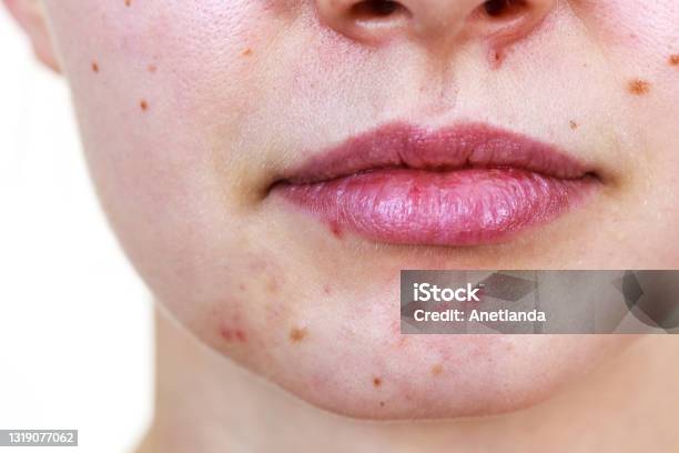 Female Face With Acne Skin Problem Stock Photo - Download Image Now - Pimple, Human Face, Acne