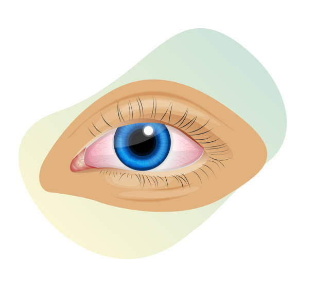 Ojos Irritados Vectores Libres de Derechos - iStock Ojos Irritados Vectores Libres de Derechos - iStock