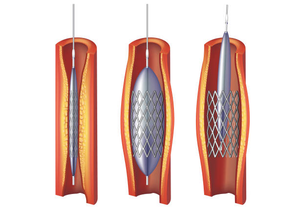 ilustraciones, imágenes clip art, dibujos animados e iconos de stock de angioplastia y stent - angioplasty