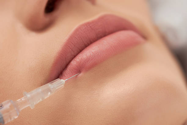 Procedure lip augmentation for young beautiful woman. stock photo