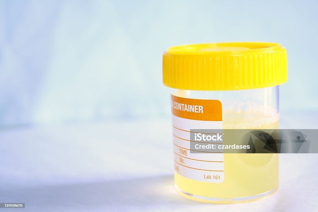 Urine sample Cloudy urine in specimen container. Urine Stock Photo