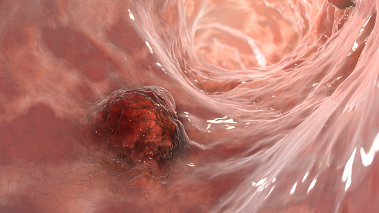 Carcinoma intestinal, cáncer colorrectal, neoplasia intestinal, ilustración 3D photo
